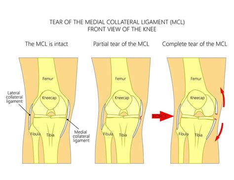 mild mcl tear recovery time